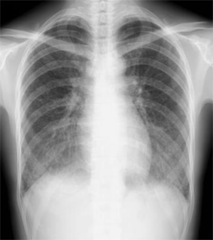 胸部X線写真：中下肺野にびまん性粒状網状影がみられる。