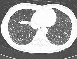 胸部ＣＴ：小葉中心性で上方は主に粒状影が、下方は斑状影がみられる。