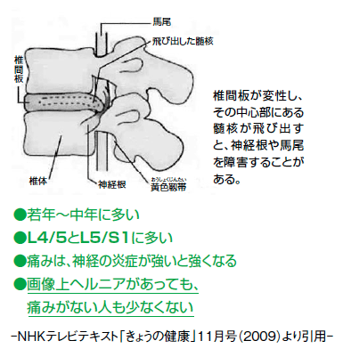 腰椎椎間板ヘルニアの概要