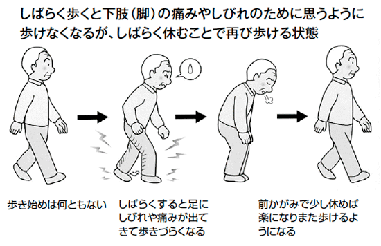 間欠性跛行とは