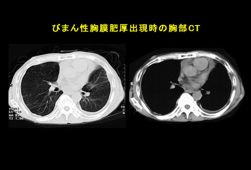 びまん性胸膜肥厚出現時の胸部CT