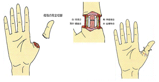 職業性外傷分野